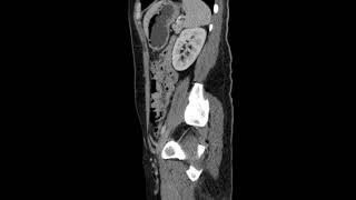 Fournier gangrene CT Sagittal [upl. by Thurston]