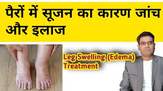 Leg swelling edema Causes tests and Treatment Explained  Pairo Me Sujan ka ilaj [upl. by Nee860]