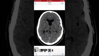 Case 078 Case Absent septum pellucidum [upl. by Notrem]