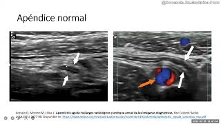 Apendicitis 7 Ecografía y anatomía del Apéndice normal [upl. by Ziagos352]