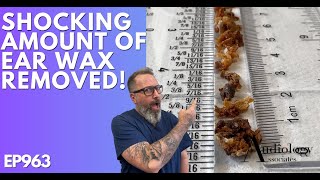 The Most Shocking Ear Wax Removal Ever  EP963 [upl. by Malvina]