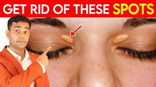 Get Rid Of These Spots  Fat Under Eyes  Xanthelasma  Natural Remedies  Dr Vivek Joshi [upl. by Nanji]