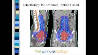 Radiation and Endometrial Cancer [upl. by Comyns995]