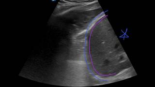 POCUS  Lung Ultrasound Understanding B Lines and Hepatization [upl. by Asiulana]