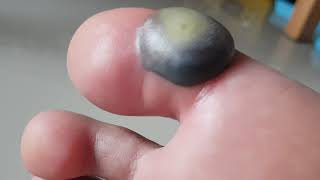 A blister after 30 hours from liquid nitrogen cryotherapy [upl. by Enimzzaj]