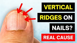 Thats The REAL Cause of VERTICAL RIDGES On Your Nails [upl. by Attena420]