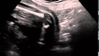 Ultrasound in Obstetrics amp Gynecology A Practical Approach  Clip 32 [upl. by Anallij]