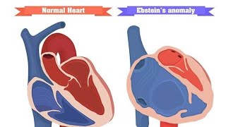 Ebsteins anomaly  class [upl. by Dee247]