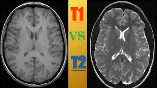 MRI basic T1 Weight vs T2 weight images Characteristic [upl. by Koeninger636]