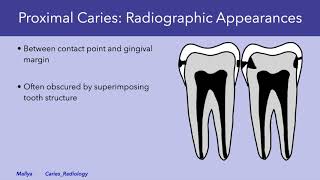 Radiologic Detection and Evaluation of Caries [upl. by Sik252]