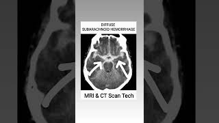 Subarachnoid Hemorrhage CT Scan viral youtubeshorts ct shortsfeed [upl. by Eyllom595]