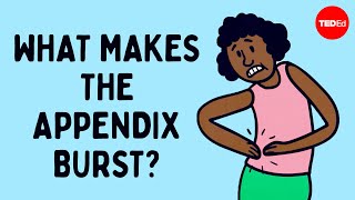 What does appendix pain feel like  David R Flum [upl. by Namreg]