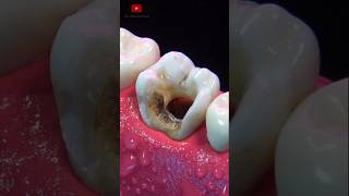 ASOMBROSA restauración dental asmr [upl. by Etnaik]