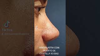 RINOPLASTIA CON INJERTO DE COSTILLA cirugiadenariz rinoplastia [upl. by Barr]