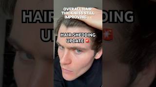 HAIR SHEDDING UPDATE 🚨 hairloss hairline [upl. by Detta]