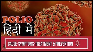 Polio DiseaseCauseSymptoms amp PreventionIn Hindi TheDarkestShow [upl. by Alhak]