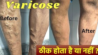 Varicose veins treatment with foam Sclerotherapy and Diode laser Result  varicose veins treatment [upl. by Eniamraj]