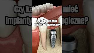 Czy każdy może mieć implanty stomatologiczne implanty implantacja implantystomatologiczne [upl. by Rehprotsirhc]