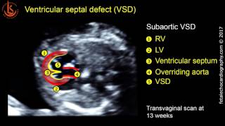 Fetal echocardiography at 1113 weeks Ventricular Septal Defect VSD [upl. by Ardnwahs435]