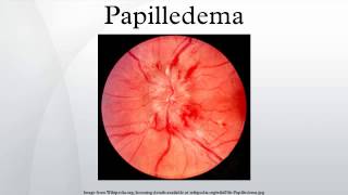 Papilledema [upl. by Ahseinaj83]