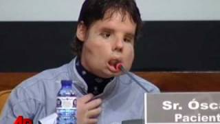 Raw Video Spain Face Transplant Man Speaks [upl. by Jo-Ann]