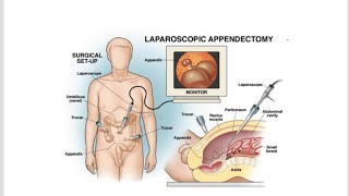 Laparoscopic Appendectomy  Procedure Benefits Indications and Contraindications [upl. by Kitarp]