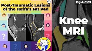 Fig 4C03 Posttraumatic Lesions of Hoffa’s Fat Pad [upl. by Trixi]