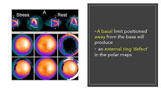 Artifacts in Nuclear Cardiology MCQs nuclearmedicineMCQ nuclearmedicine physics RSO frcr [upl. by Anec]