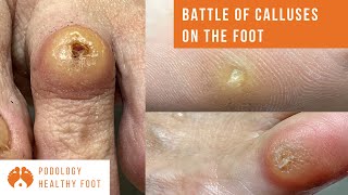 BATTLE OF CALLUSES ON THE FOOT 3 calluses removal on different parts of the foot ASMR podologia [upl. by Fong626]