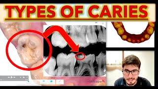 CARIES for Beginners Clinical Vs Bitewings ICDAS classification cavity teeth class IOS Trios 5 [upl. by Etterrag]