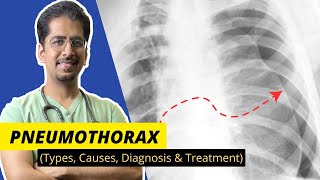 PNEUMOTHORAX Types Causes Diagnosis amp Treatment  Detailed video [upl. by Hicks]