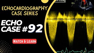 ECHO CASE 92  Echocardiography for Beginners  Echocardiogram Interpretation  2D Echo Basics [upl. by Inilahs331]