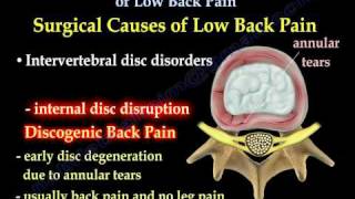 Low Back Painsciatica Disc surgery Everything You Need To Know  Dr Nabil Ebraheim [upl. by Taggart906]