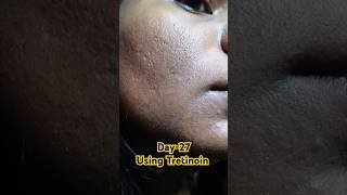 Day27 Using Tretinoin 0025 cream viralvideo tretinoin tretinoincream shorts youtubeshorts [upl. by Southard]