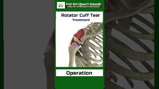 Treatment of rotator cuff tear   Dr Ujjwal K Debnath [upl. by Aener439]