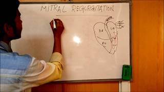 MITRAL REGURGITATION  DEFINITIONCAUSESSIGNSSYMPTOMSPATHOPHYSIOLOGY AND TREATMENT [upl. by Pence702]