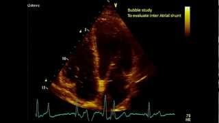 Apical views  Transthoracic Echocardiogram TTE [upl. by Suiradel]