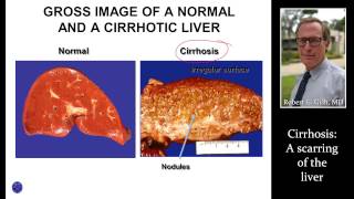 CIRRHOSIS LIVER SCARRING by Dr Robert Gish [upl. by Akimyt]