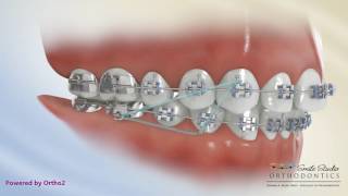 Elastics  Class II Triangle 3 to 46  Orthodontic Treatment [upl. by Odelle492]