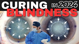 Curing Blindness  Full Surgery [upl. by Ahsinyar]