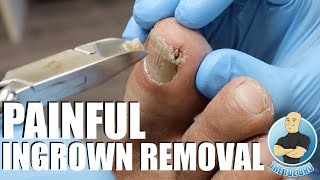 TREATING AN EXTREMELY PAINFUL INGROWN TOENAIL WITH HOW TO ADVICE [upl. by Goren]