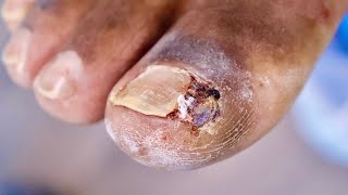 His Last Surgery FAILEDJUICY INFECTED INGROWN TOENAIL [upl. by Ennovehc]