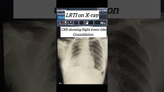 Typical example of LRTI on xray  lower respiratory tract infection doctor study students [upl. by Cyna]