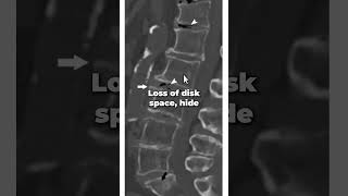 What does spinal degenerative disc disease look like [upl. by Annehsat]