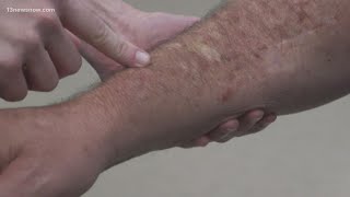 Skin Cancer How to spot melanoma warning signs [upl. by Joslyn]