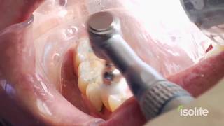 Dental Restoration with Isolite [upl. by Jb]