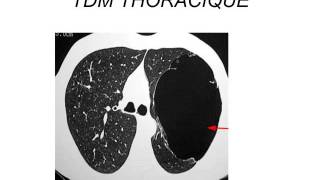 PNEUMOLOGIE broncho pneumopathie chronique obstructive 2015 [upl. by Brennen]