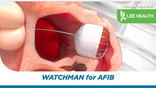 WATCHMAN for AFIB [upl. by Learsi662]