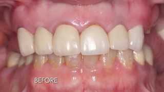 Dental Implant Reconstruction with Prosthodontist Dr David McFadden [upl. by Nalra]