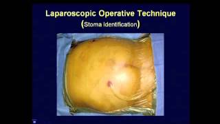 Parastomal Hernia Repair � Best Techniques Kristi Harold MD [upl. by Lange]